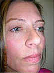 Before and After Pictures | Femme Clinic