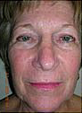 Before and After Pictures | Femme Clinic