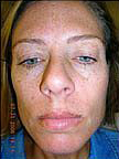 Before and After Pictures | Femme Clinic
