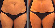 פאם-קליניק - המרכז לקוסמטיקה מתקדמת - before and after