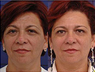Before and After Pictures | Femme Clinic