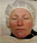 Rosacea and Acne Treatments | Femme Clinic