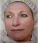 Rosacea and Acne Treatments | Femme Clinic