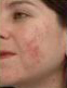 Rosacea and Acne Treatments | Femme Clinic