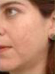Rosacea and Acne Treatments | Femme Clinic