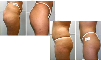 פאם-קליניק - המרכז לקוסמטיקה מתקדמת - before and after