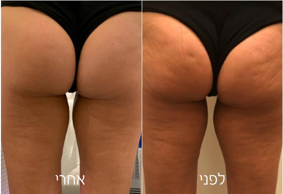LPG לצלוליט והצרת היקפים | פאם קליניק