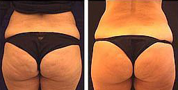 פאם-קליניק - המרכז לקוסמטיקה מתקדמת - before and after