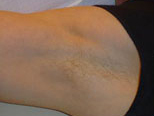 Laser?  Light Treatment?  Electrolysis?  Infra red? | Femme Clinic