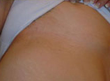 Laser?  Light Treatment?  Electrolysis?  Infra red? | Femme Clinic