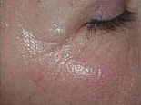 Before and After Pictures | Femme Clinic