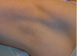 Laser?  Light Treatment?  Electrolysis?  Infra red? | Femme Clinic
