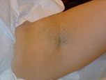 Laser?  Light Treatment?  Electrolysis?  Infra red? | Femme Clinic