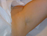 Laser?  Light Treatment?  Electrolysis?  Infra red? | Femme Clinic