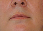 Laser?  Light Treatment?  Electrolysis?  Infra red? | Femme Clinic