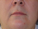 Laser?  Light Treatment?  Electrolysis?  Infra red? | Femme Clinic