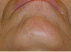Laser?  Light Treatment?  Electrolysis?  Infra red? | Femme Clinic
