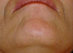 Laser?  Light Treatment?  Electrolysis?  Infra red? | Femme Clinic