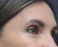 Before and After Pictures | Femme Clinic
