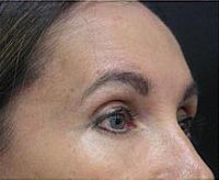 Before and After Pictures | Femme Clinic