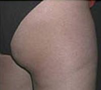 פאם-קליניק - המרכז לקוסמטיקה מתקדמת - before and after