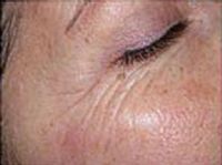 Before and After Pictures | Femme Clinic