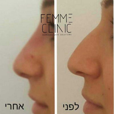 פאם-קליניק - המרכז לקוסמטיקה מתקדמת - פיסול אף
