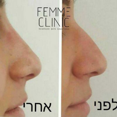 פאם-קליניק - המרכז לקוסמטיקה מתקדמת - פיסול אף