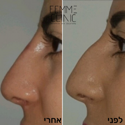 פאם-קליניק - המרכז לקוסמטיקה מתקדמת - פיסול אף