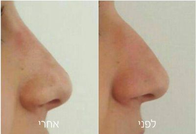 חומצה הילארונית - פיסול פנים למראה טבעי | פאם קליניק