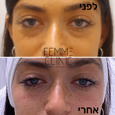פאם-קליניק - המרכז לקוסמטיקה מתקדמת - מילוי שקעים מתחת לעיניים