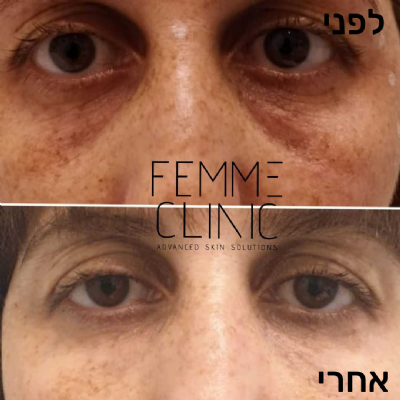 פאם-קליניק - המרכז לקוסמטיקה מתקדמת - מילוי שקעים מתחת לעיניים
