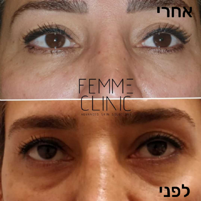 פאם-קליניק - המרכז לקוסמטיקה מתקדמת - מילוי שקעים מתחת לעיניים
