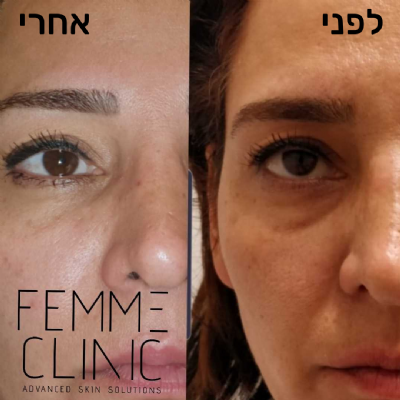 פאם-קליניק - המרכז לקוסמטיקה מתקדמת - מילוי שקעים מתחת לעיניים