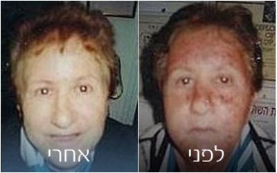 טיפולים נגד כתמים ופיגמנטציה | פאם קליניק