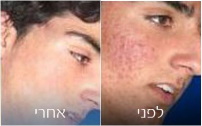 טיפולים נגד כתמים ופיגמנטציה | פאם קליניק