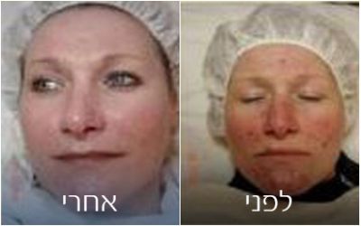 טיפולים נגד כתמים ופיגמנטציה | פאם קליניק